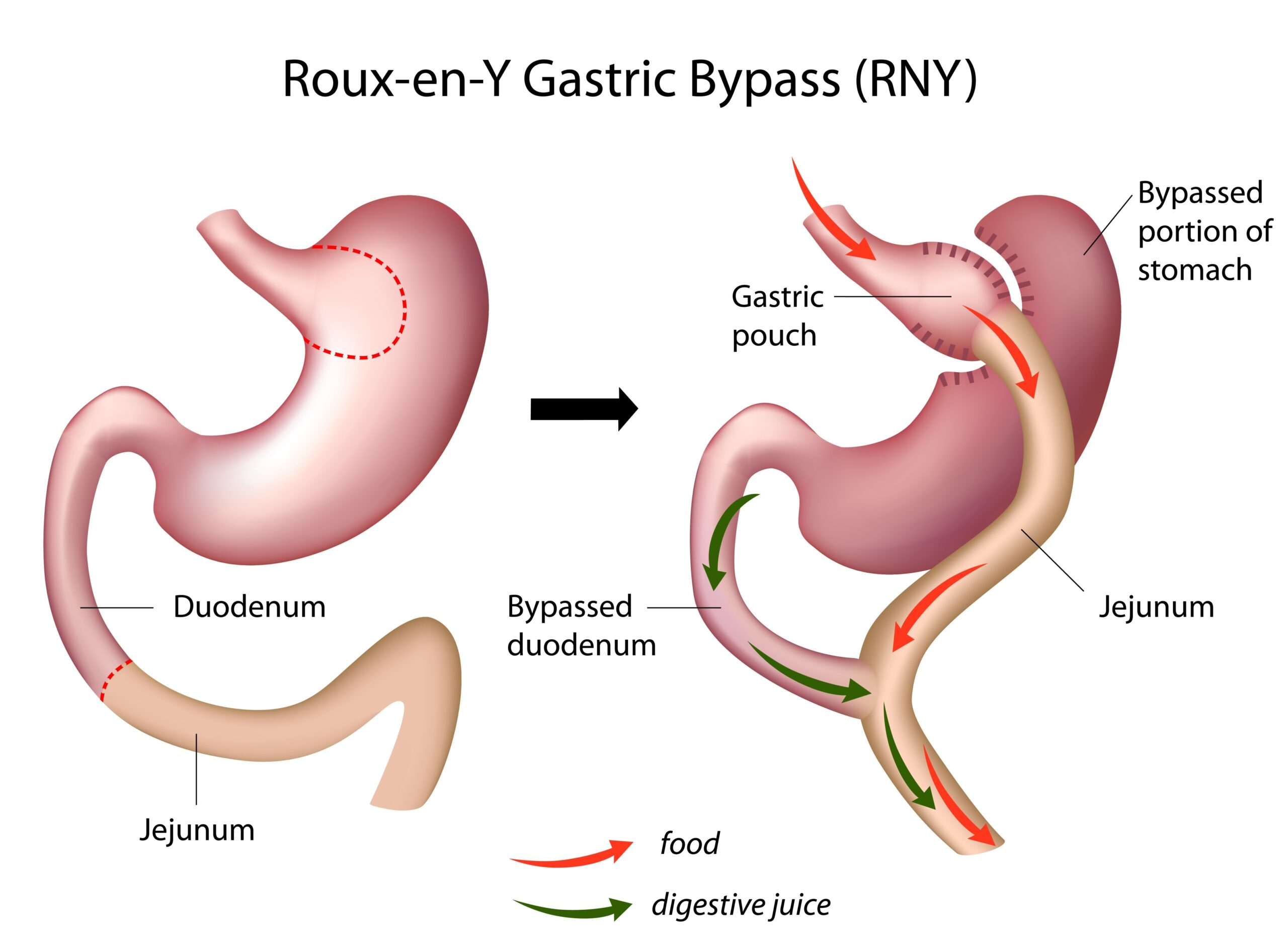 Roux-en-Y gastric bypass diagram