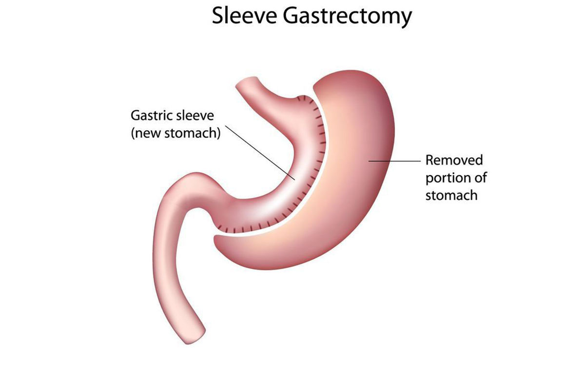 Gastric Sleeve