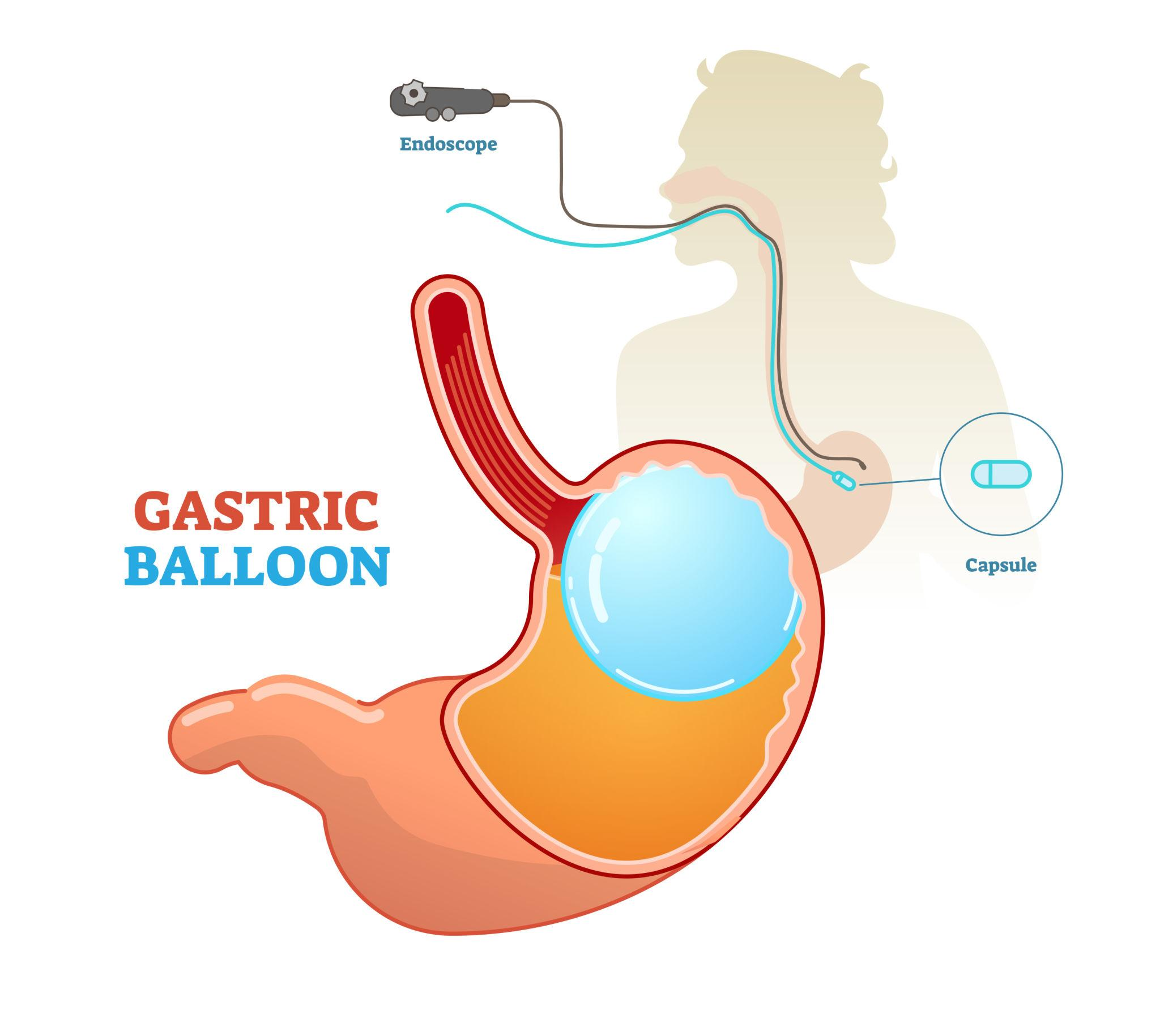 Gastric balloon illustration